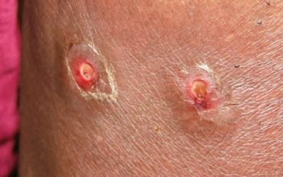 How to Protect Yourself from the ‘Mango’ Bot Fly Infestation